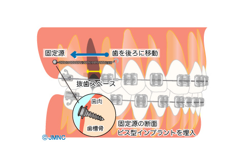 インプラント矯正（ミニスクリュー）